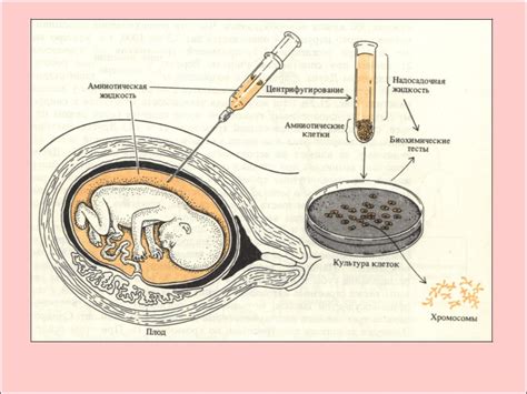 Амниоцентез: эффективный метод диагностики нарушений генетического материала