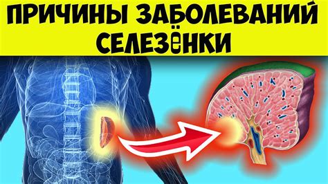 Аномальное положение селезенки: что следует знать