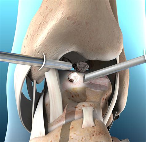 Артроскопия колена: инновационная техника восстановления мениска