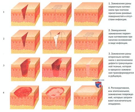 Важность психологической поддержки в процессе улучшения заживления ран у пациентов с диабетом