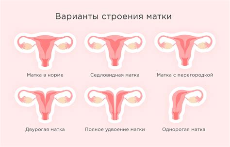 Влияние врожденных отклонений матки на местоположение хориона