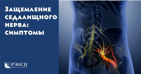 Влияние патологических состояний позвоночника на сдавливание седалищного нерва