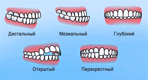 Влияние питания на формирование прикуса у ребенка