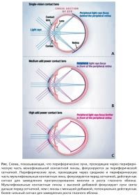 Влияние разной выпуклости контактных линз на остроту зрения: ключевые аспекты