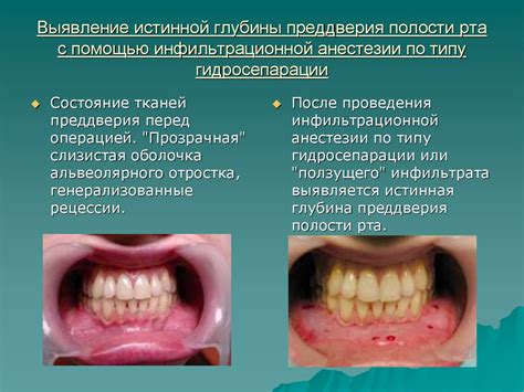 Воздействие ГЭРБ на ощущение зноя в полости рта и способы его смягчения