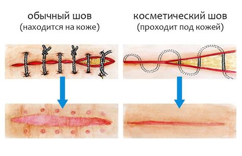 Возможные осложнения при расходящихся швах