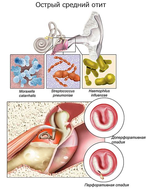 Воспаление среднего уха