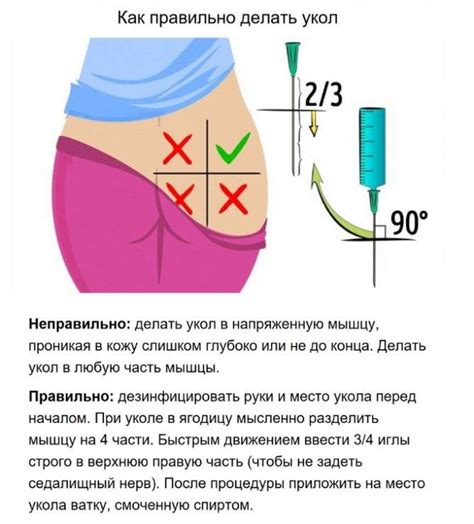 Выбор безопасного места для введения лекарственного препарата в ягодицу: важные советы