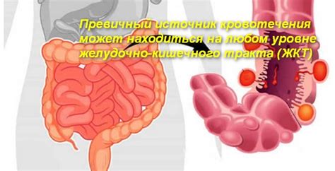 Геморрой: главная причина кровотечения из анального прохода