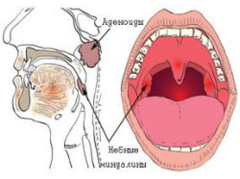 Гланды и аденоиды – важные органы нашего организма