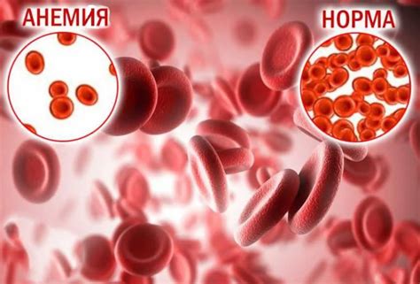 Диагностика анемии гемолитической у взрослых: методы и исследования