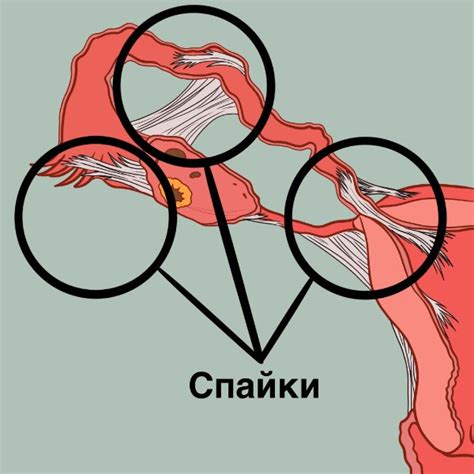 Диагностика и выявление спайки в мышцах под плечелопаточным комплексом