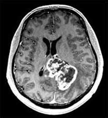 Диагностика и лечение глиобластомы и астроцитомы