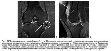 Диагностика поражения хрящевого зобчатого полумесяца коленного сустава