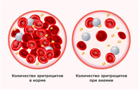 Железодефицитная анемия и ее воздействие на уровень железа в крови