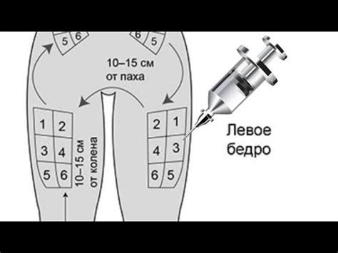 Корректное обеззараживание уколов в области ягодиц