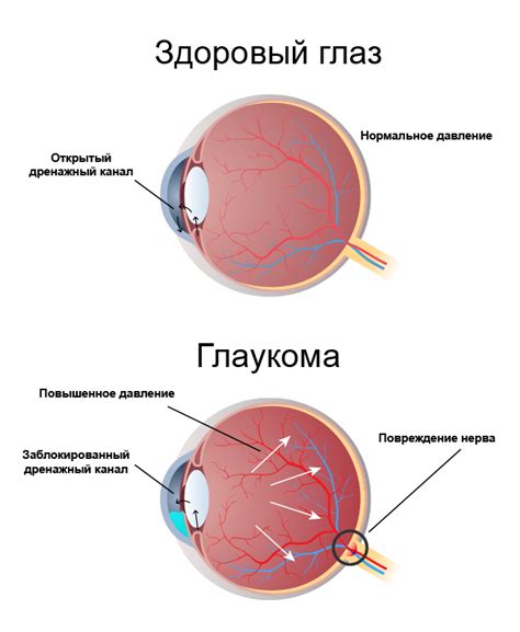 Лечение глаукомы: методы и препараты