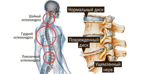 Лечение деформаций позвоночника: терапевтические стратегии и методы