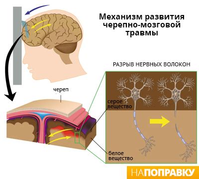 Метеозависимость после перенесенного травматического сотрясения головы у взрослых