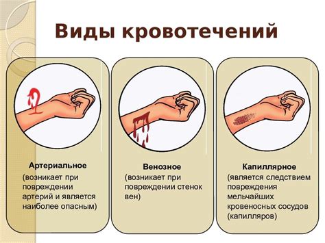 Механизмы возникновения и способы прекращения кровотечения