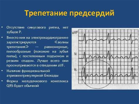 Механизм отображения синусового ритма на электрокардиограмме