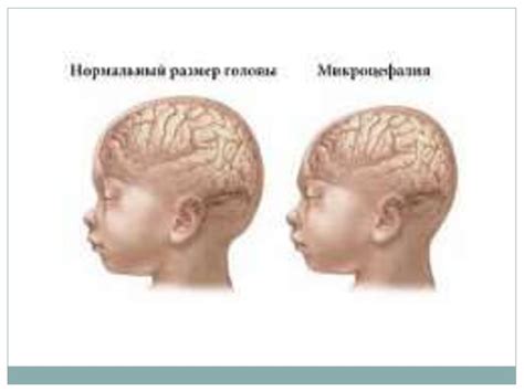 Механизм развития гидроцефалии