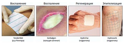 Наложение специальных повязок для быстрого заживления после инъекции в области ягодиц