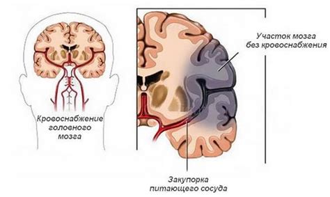 Нарушения кровообращения в головном мозге