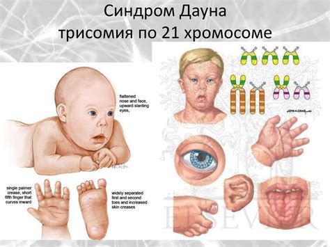 Наследственные заболевания как предрасполагающий фактор дефектов мозга у плода