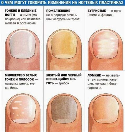 Негативные последствия некорректного ухода за ногтями