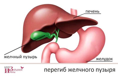 Обзор симптомов и причин перегиба желчного пузыря