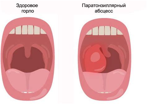 Обнаружение абсцесса на ягодице: основные симптомы и методы диагностики