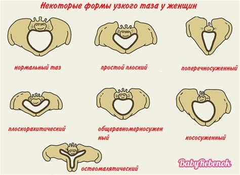 Обнаружение характерных признаков узкого таза при визуальном осмотре