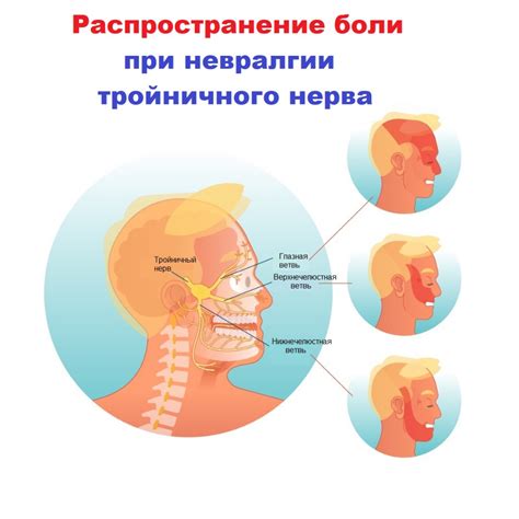 Описание и симптомы компрессии иконки грушевидного нерва