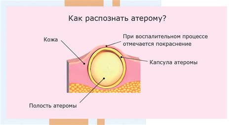 Определение и основные характеристики атеромы на зрительном органе