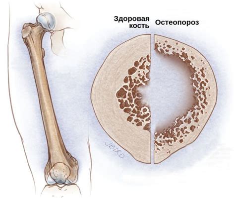 Ослабление костной ткани и увеличение вероятности переломов