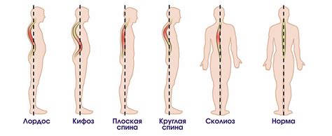 Основные рекомендации для предупреждения возникновения деформации позвоночника