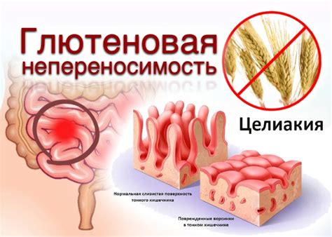 Основные симптомы глютеновой непереносимости: