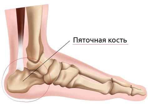 Основные способы лечения экзостоза пяточной кости