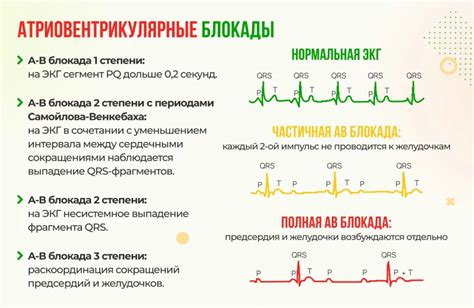 Основные черты внутрипредсердной блокады 1 степени на ЭКГ