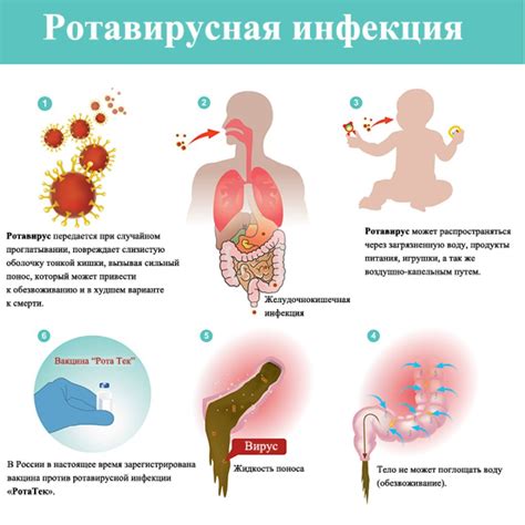 Особенности ротовирусной инфекции у детей и методы лечения