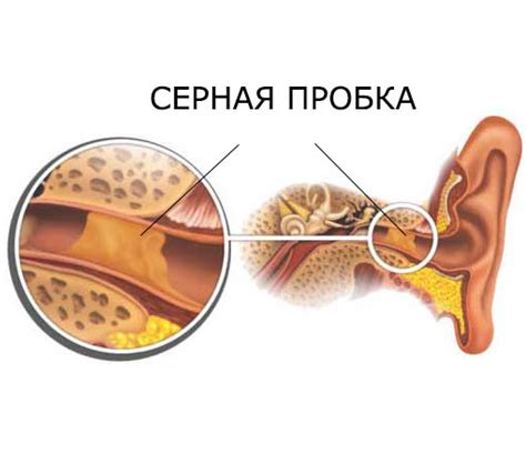 Отложившиеся серные пробки в ушной раковине: проблема серы и ее последствия