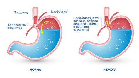 Ощущение жгучего дискомфорта: что такое изжога и как она проявляется