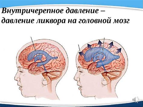 Повышенное внутричерепное давление и сонливость: причины и советы по снятию симптомов