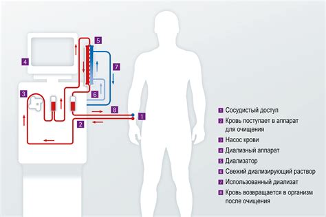 Показания для осуществления гемодиализа