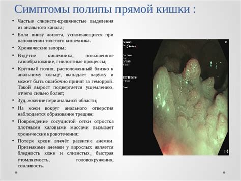 Полипы в области прямой кишки: еще один фактор возникновения кровотечения, требующий внимания