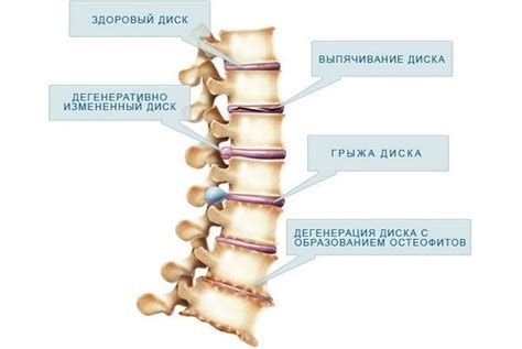 Последствия непредусмотренных изменений в структуре позвоночника