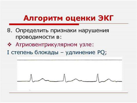 Признаки нарушения проводимости в сердце, выявляемые при проведении ЭКГ