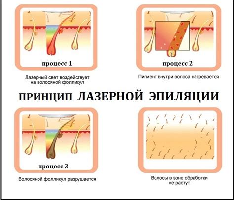 Принцип работы лазерной эпиляции и механизм удаления волос
