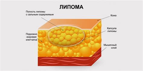 Причины и характеристики появления жировика на теле